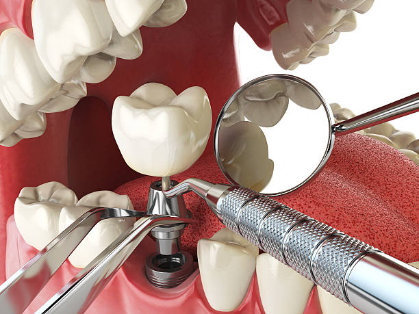 Best Emergency Dental Care for Broken or Chipped Teeth in Georgetown, CT